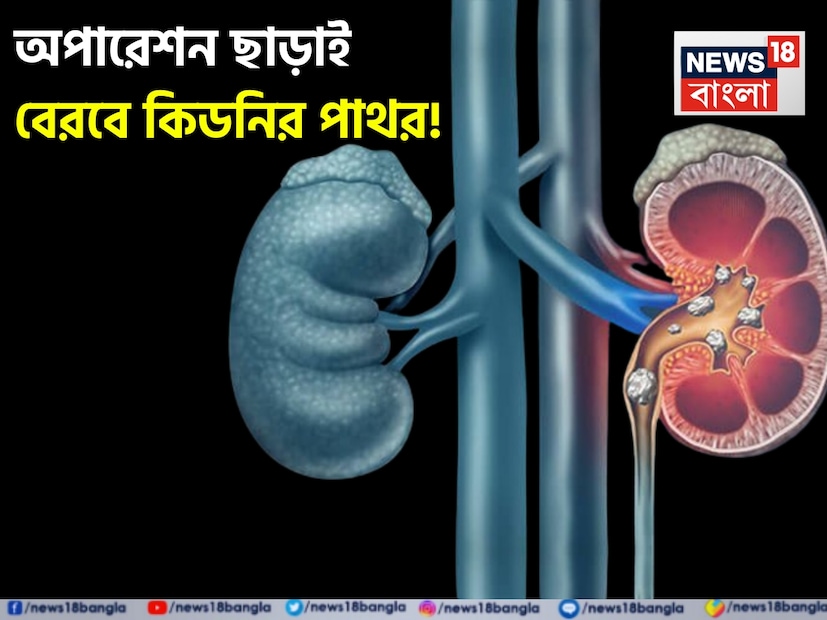 কিডনিতে পাথরের সমস্যা আজকাল দ্রুত বৃদ্ধি পাচ্ছে। বিপুল সংখ্যক তরুণ কিডনিতে পাথরের সমস্যায় ভুগছেন। ভুল খাদ্যাভ্যাস, অস্বাস্থ্যকর জীবনধারা এবং কম জল পান করার কারণে কিডনিতে পাথর তৈরি হয়। পাথরের আকার ছোট হলে, এটি প্রস্রাবের মাধ্যমে নিজে থেকেই বেরিয়ে আসে এবং অস্ত্রোপচারের প্রয়োজন হয় না। কিডনিতে পাথরের সমস্যা আজকাল দ্রুত বৃদ্ধি পাচ্ছে। বিপুল সংখ্যক তরুণ কিডনিতে পাথরের সমস্যায় ভুগছেন। ভুল খাদ্যাভ্যাস, অস্বাস্থ্যকর জীবনধারা এবং কম জল পান করার কারণে কিডনিতে পাথর তৈরি হয়। পাথরের আকার ছোট হলে, এটি প্রস্রাবের মাধ্যমে নিজে থেকেই বেরিয়ে আসে এবং অস্ত্রোপচারের প্রয়োজন হয় না।