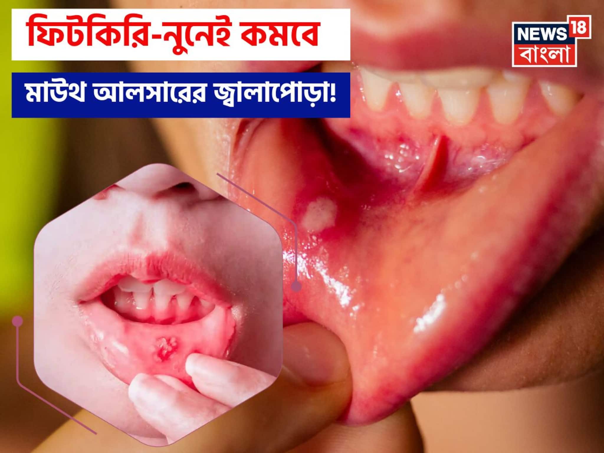 Mouth Ulcer Home Remedies: ১ চিমটে ফিটকিরি আর নুনেই কমবে জ্বালাপোড়া! মাউথ আলসারের যন্ত্রণায় চোখে জল আসার দিন শেষ!