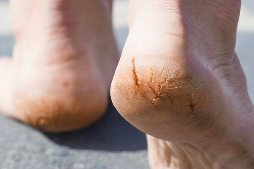 ডাঃ রাজকুমার বলেন যে ডিহাইড্রেশন হল গোড়ালি ফাটার একটি সাধারণ কারণ। যখন আমরা পর্যাপ্ত জল পান করি না, তখন ত্বক আর্দ্রতা হারায়, যার ফলে ত্বক শুষ্ক হয়ে ফেটে যায়। তাই, সারাদিনে কমপক্ষে ৮ থেকে ১০ গ্লাস জল পান করা গুরুত্বপূর্ণ। প্রতি রাতে ঘুমানোর আগে গোড়ালিতে নারকেল তেল বা গ্লিসারিন লাগানো পায়ের যত্নের জন্য উপকারী। এটি ত্বককে প্রয়োজনীয় আর্দ্রতা প্রদান করে এবং ফাটা সারাতে সাহায্য করে।