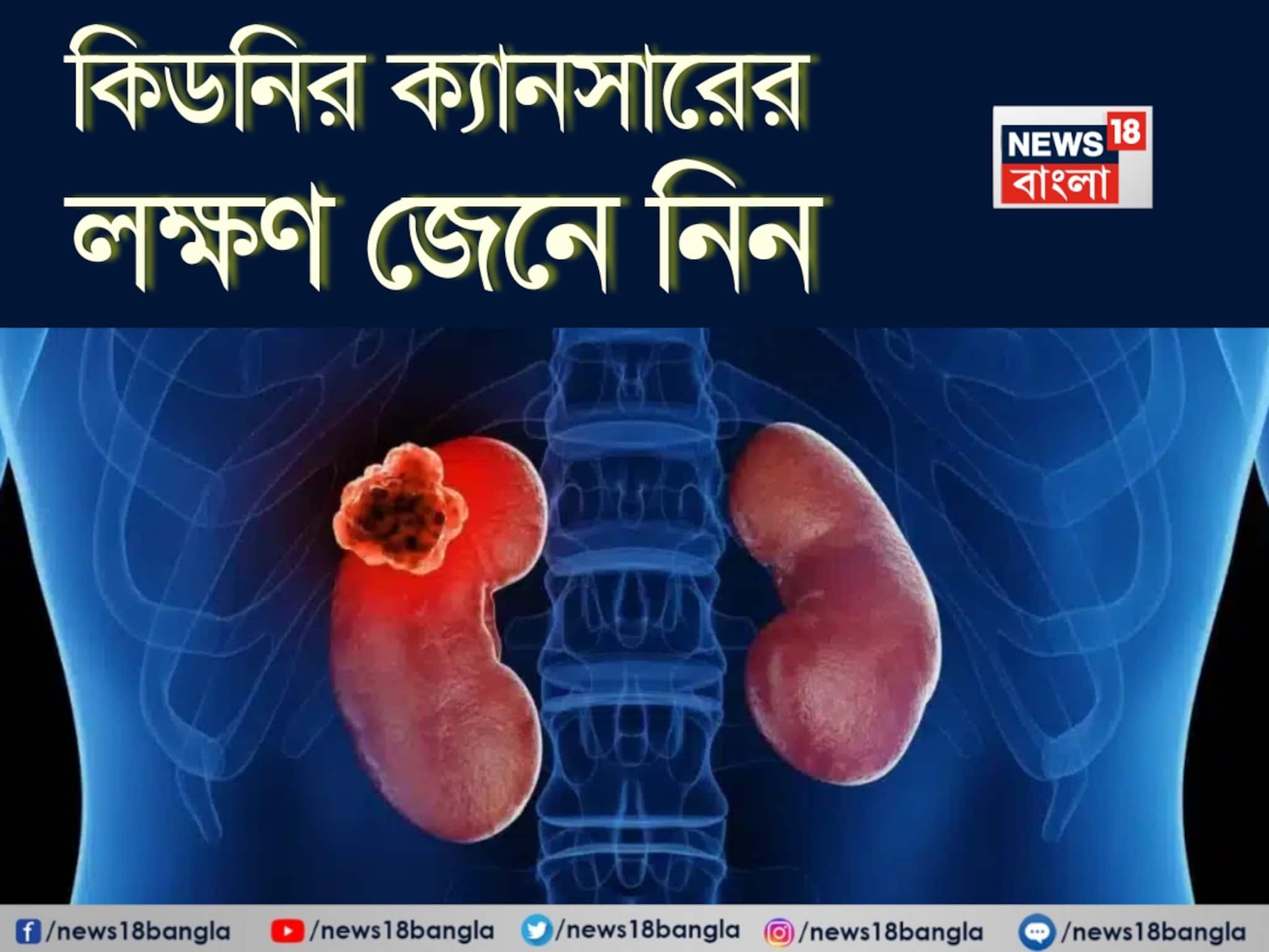 Kidney Cancer Symptoms: কিডনির ক্যানসারের লক্ষণ কী কী, কখন সতর্ক হবেন, জেনে নিন! বলছেন বিশেষজ্ঞ চিকিৎসক