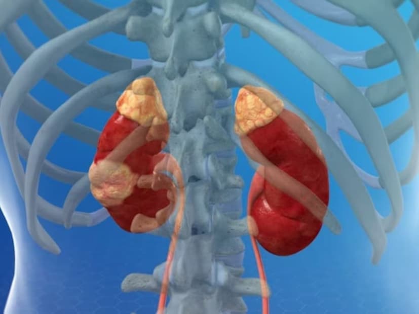  সময়ের সঙ্গে সঙ্গে যে লক্ষণ ও উপসর্গগুলি দেখা দিতে পারে তার মধ্যে রয়েছে প্রস্রাবে রক্ত, যা গোলাপি, লালচে বা কোলা রঙের মনে হতে পারে৷ পিঠের পিছন দিকে ব্যথা হতে পারে লাগাতার বা বিচ্ছিন্ন ভাবে৷