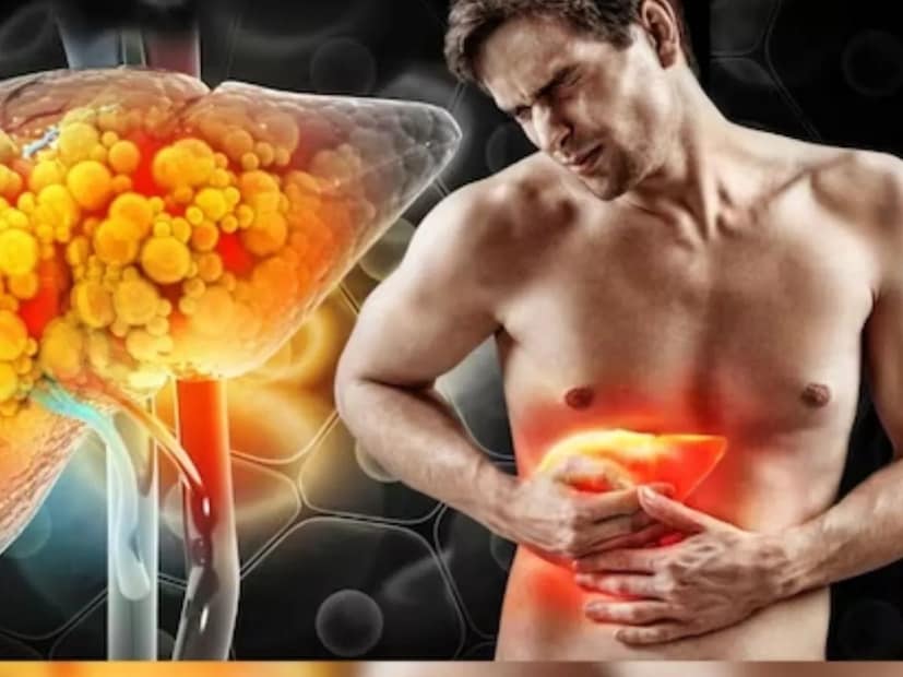  অতএব, ফ্যাটি লিভার রোগের লক্ষণগুলি সনাক্ত করা অত্যন্ত গুরুত্বপূর্ণ। প্রাথমিকভাবে সনাক্তকরণ জীবনধারা পরিবর্তন এবং চিকিৎসা হস্তক্ষেপের দিকে পরিচালিত করতে পারে যা আরও লিভারের ক্ষতি রোধ করে। ডাঃ সৌরভ শেঠি, যিনি অন্ত্রের ডাক্তার হিসেবে পরিচিত, যিনি এইমস, হার্ভার্ড এবং স্ট্যানফোর্ড বিশ্ববিদ্যালয়ে প্রশিক্ষণপ্রাপ্ত একজন গ্যাস্ট্রোএন্টেরোলজিস্ট, তিনি ফ্যাটি লিভারের ৮টি সতর্কতামূলক লক্ষণ শেয়ার করেছেন যা আপনার উপেক্ষা করা উচিত নয়।