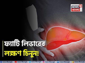 পচবে লিভার! হতে পারে ক্যানসারও! ভুঁড়ি, ক্লান্তি, পেটব্যথা...চিনুন ফ্যাটি লিভারের লক্ষণ! পচবে লিভার! হতে পারে ক্যানসারও! ভুঁড়ি, ক্লান্তি, পেটব্যথা...চিনুন ফ্যাটি লিভারের লক্ষণ!