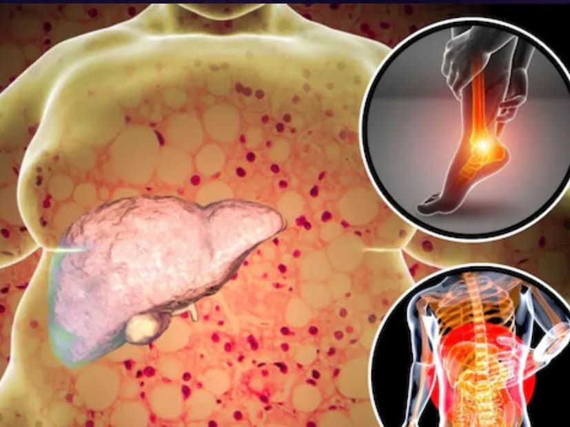 যদি আপনার পেটে হঠাৎ ফোলাভাব বা পা এবং গোড়ালি ফুলে যায়, তাহলে এটিকে হালকাভাবে নেবেন না। এটিকে চিকিৎসা বিজ্ঞানে এডিমা বা অ্যাসাইটস বলা হয়। এটি তখন ঘটে যখন লিভার রক্ত সঞ্চালন এবং তরল ভারসাম্য সঠিকভাবে পরিচালনা করতে অক্ষম হয়।