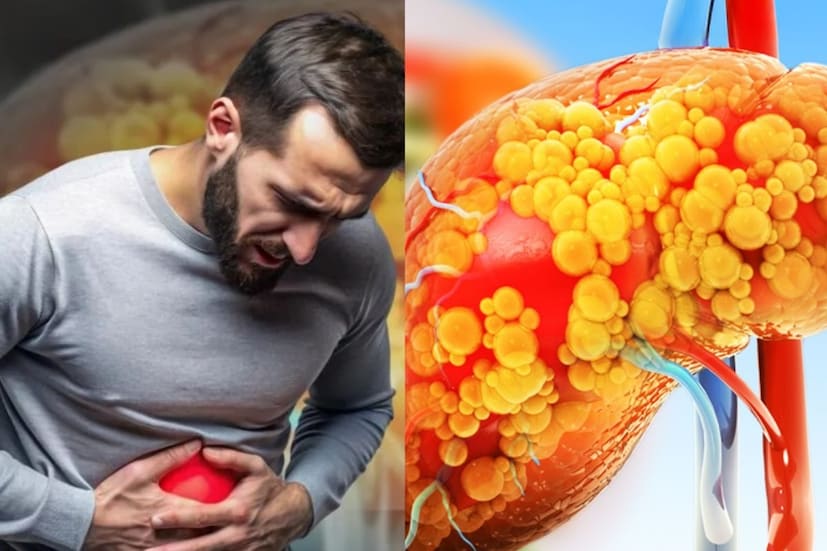 ফ্যাটি লিভারের প্রাথমিক লক্ষণগুলি পেট থেকে শুরু হয়। তবে, মানুষ প্রায়শই ছোটখাটো পেটের সমস্যাগুলিকে স্বাভাবিক বলে মনে করে উপেক্ষা করে। এর মধ্যে রয়েছে গ্যাস, পেট ফাঁপা, বা ক্ষুধা হ্রাস। তবে আপনার এই ভুল করা উচিত নয়। আপনি যদি একটি সুস্থ লিভার নিয়ে বাঁচতে চান, তাহলে এই লক্ষণগুলিকে গুরুত্ব সহকারে নেওয়া শুরু করুন৷ বলছেন পুষ্টিবিদ লভনীত বাত্রা৷