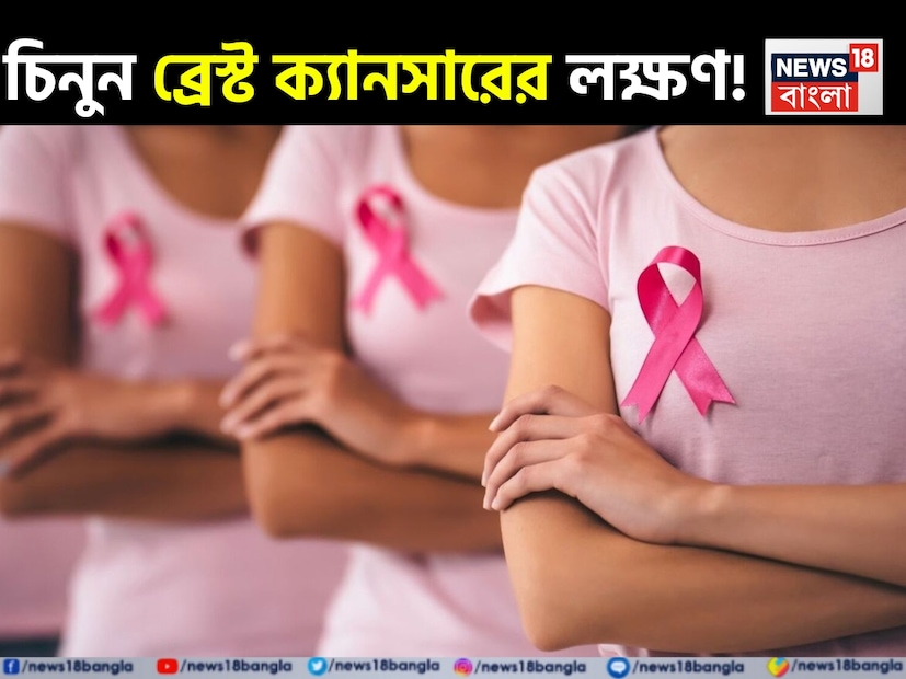 বিশ্বজুড়ে মহিলাদের মধ্যে স্তন ক্যানসার এখনও বহুল প্রচারিত ক্যানসার, এবং ভারতীয় উপমহাদেশে এর ভার বিশেষভাবে তাৎপর্যপূর্ণ, যেখানে বেশিরভাগ ক্ষেত্রেই এই রোগ উন্নত পর্যায়ে ধরা পড়ে। বহু বছর ধরে, স্বাস্থ্য শিক্ষা প্রচারণাগুলি একটি ব্যথাহীন পিণ্ডকে স্তন ক্যানসারের সবচেয়ে সাধারণ লক্ষণ বলে চিহ্নিত করে আসছে। তবে, একটি গুরুত্বপূর্ণ বাস্তবতা প্রায়ই অলক্ষিত থাকে। স্তন ক্যানসার সর্বদা পিণ্ডের সঙ্গেই আসে না। বরং মৃদু, নীরব সতর্কতামূলক লক্ষণ হিসেবেও দেখা দেয় যা প্রতিটি মহিলার সচেতন হওয়া উচিত। বিশ্বজুড়ে মহিলাদের মধ্যে স্তন ক্যানসার এখনও বহুল প্রচারিত ক্যানসার, এবং ভারতীয় উপমহাদেশে এর ভার বিশেষভাবে তাৎপর্যপূর্ণ, যেখানে বেশিরভাগ ক্ষেত্রেই এই রোগ উন্নত পর্যায়ে ধরা পড়ে। বহু বছর ধরে, স্বাস্থ্য শিক্ষা প্রচারণাগুলি একটি ব্যথাহীন পিণ্ডকে স্তন ক্যানসারের সবচেয়ে সাধারণ লক্ষণ বলে চিহ্নিত করে আসছে। তবে, একটি গুরুত্বপূর্ণ বাস্তবতা প্রায়ই অলক্ষিত থাকে। স্তন ক্যানসার সর্বদা পিণ্ডের সঙ্গেই আসে না। বরং মৃদু, নীরব সতর্কতামূলক লক্ষণ হিসেবেও দেখা দেয় যা প্রতিটি মহিলার সচেতন হওয়া উচিত।