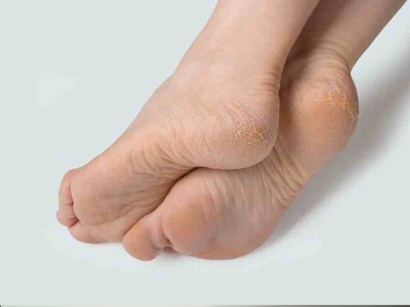 পায়ে বেশি প্রেশার পড়লেও পা ফাটতে থাকে। যাঁরা অনেক ক্ষণ দাঁড়িয়ে কাজ করেন, তাঁদের পা ফাতার প্রবণতা বেশি। পাশাপাশি, বয়সের সঙ্গে সঙ্গে ত্বকের ইসাস্টিসিটি কমে যায়, ত্বক শুষ্ক হয়ে যায়, ফলে ফাটা গোড়ালির প্রবণতা বাড়ে।