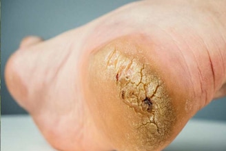 শীতে ফাটা পা, দামি ক্রিম-লোশন নয়, মধু, কলার মতো ঘরোয়া টোটকায় পান নরম, তুলতুলে গোড়ালি