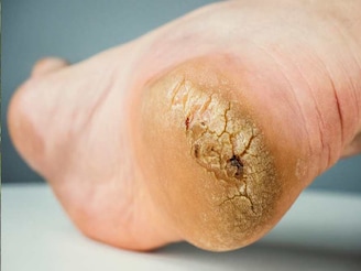 শীতে ফাটা পা, দামি ক্রিম-লোশন নয়, মধু, কলার মতো ঘরোয়া টোটকায় পান নরম, তুলতুলে গোড়ালি