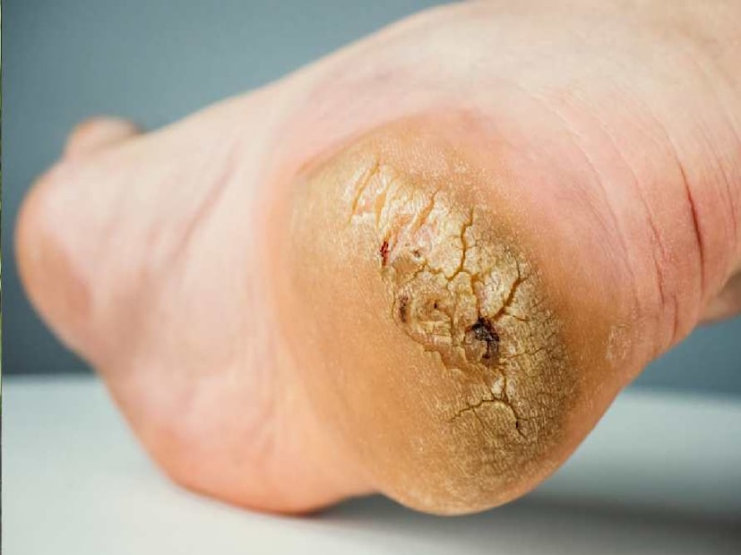 পা কেন ফাটে? শীতে হাওয়ায় আদ্রতা কম থাকে, ফলে আবআওয়ার পাশাপাশি ত্বকও শুষ্ক হয়ে পড়ে! এমনিতেই গোড়ালিতে অয়েল গ্ল্যান্ড খুব কম। শীতে এই গ্ল্যান্ডগুলি আরও নিষ্ক্রিয় হয়ে পড়ে, ফলে পা ফাটতে থাকে। 