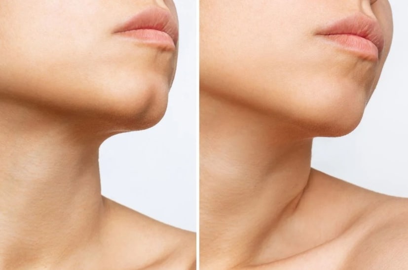 কোনও ব্যক্তিত্বকে বোঝার জন্য সাধারণ কিছু প্রচলিত টিপস রয়েছে। কিছু মানুষ অন্যদের ব্যক্তিত্ব বুঝতে পারে, এবং সেটা কিছুটা হলেও তারা সঠিক হয়। কারও চিবুক দেখে নেওয়া যাক তাদের ব্যক্তিত্ব কেমন হতে পারে তা বোঝার জন্য। আপনি কি কখনও ফাটা চিবুক দেখেছেন, যা চিবুকের ডিম্পল নামেও পরিচিত? এটি একটি জেনেটিক বৈশিষ্ট্য যা বৃদ্ধির সময় নীচের চোয়ালের দুই পাশ সম্পূর্ণরূপে একত্রিত না হলে ঘটে। এর ফলে চিবুকের মাঝখানে একটি ছোট দাগ তৈরি হয়৷ তবে আকার এবং গভীরতায় এটা এক একের জন্য এক একরকম হতে পারে।