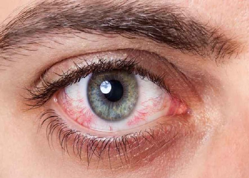 আরেকটি উল্লেখযোগ্য রোগ হল ডায়াবেটিক ম্যাকুলার এডিমা, যেখানে রেটিনার ম্যাকুলায় তরল জমা হয়। ডায়াবেটিসে আক্রান্ত ব্যক্তিদের ছানি এবং গ্লুকোমার ঝুঁকিও বেশি থাকে, গবেষণায় দেখা গিয়েছে যে ডায়াবেটিস রোগীদের এই সমস্যাগুলি অন্যদের তুলনায় বহুগুণ বেশি হয়ে থাকে।