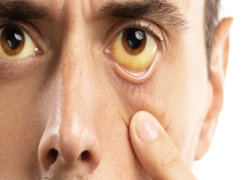 চক্ষুবিশেষজ্ঞদের মতে, এই পরিবর্তনগুলি অনেক সময় বুকে ব্যথা বা হাঁসফাঁসের মতো স্পষ্ট উপসর্গ দেখা দেওয়ার আগেই চোখে ধরা পড়ে। চোখের রক্তনালী অত্যন্ত সূক্ষ্ম ও সংবেদনশীল হওয়ায় সেখানে ক্ষতি হয় প্রথমে, এরপর ধীরে ধীরে তার প্রভাব পড়ে হার্টে।