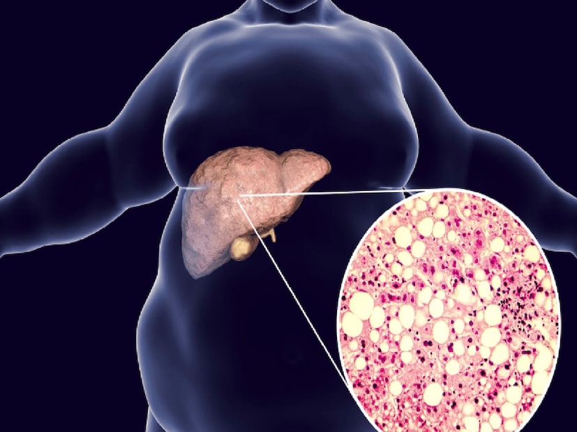 তাই স্বাভাবিক উপায়ে যকৃতকে নিয়মিত ডিটক্স করা জরুরি। ড. হংসা যোগেন্দ্র তাঁর ভিডিওতে এই ডিটক্সের দুইটি সহজ রেসিপি শেয়ার করেছেন।