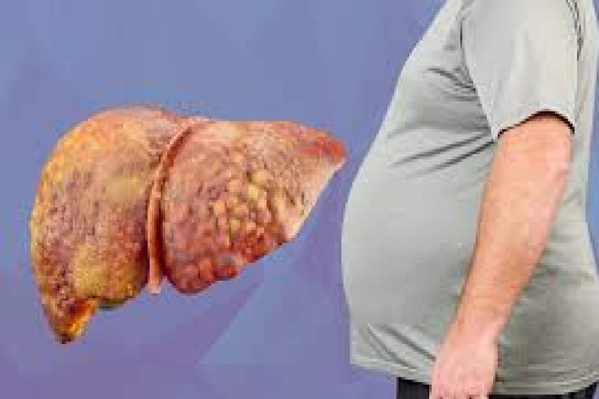 ঘরে ঘরে  ফ্যাটি লিভার! তবে তা প্রতিরোধের ঘরোয়া উপায়ও আছে কিন্তু... বিশেষজ্ঞ কী বলছে জেনে