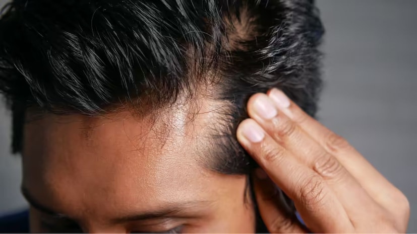 আমরা অনেক সময়ই বুঝতে পারি না, ঠিক কী কারণে মুহূর্তের মধ্যে দলা দলা চুল পরে যায়? মাথা হয়ে যায় ফাঁকা! আসল কারণ কিন্তু লুকিয়ে থাকে শরীরের মধ্যেও!