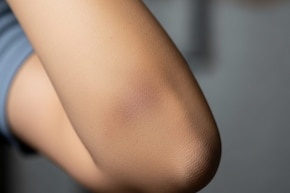 কনুইয়ের কালচে ছোপ নিমেষে উধাও! ঝকঝকে গোলাপি ত্বক পেতে ভরসা এই ঘরোয়া টোটকা