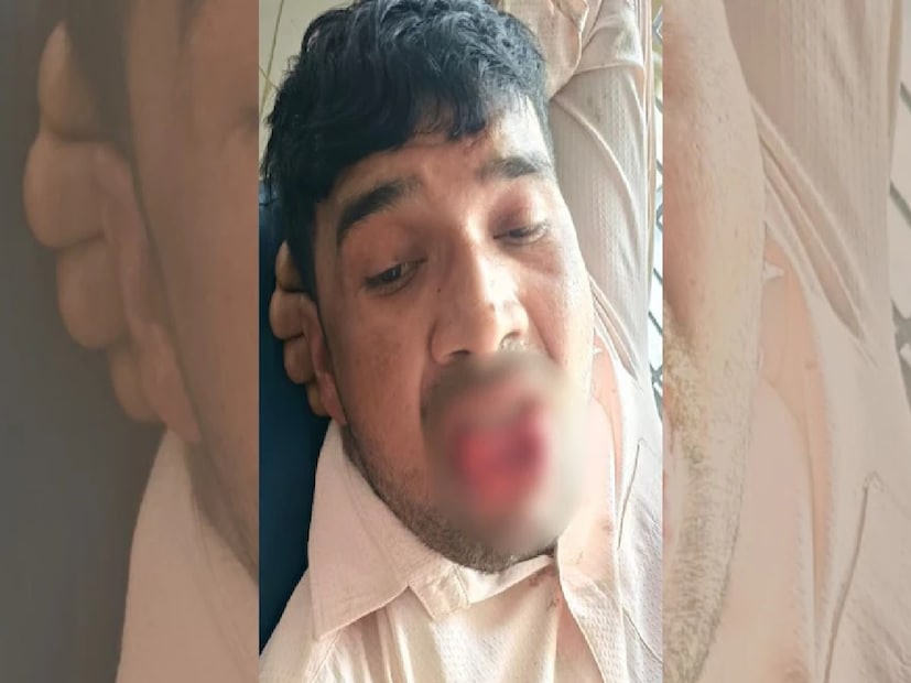 চম্পি যন্ত্রণায় চিৎকার করে ওঠে, সেই সময় তার জিভ থেকে প্রচুর রক্তক্ষরণ হচ্ছিল। তার চিৎকার শুনে গ্রামবাসীরা জড়ো হয়ে তার পরিবারকে খবর দেয়, যারা তাকে কমিউনিটি হেলথ সেন্টারে (সিএইচসি) নিয়ে যায়। প্রাথমিক চিকিৎসার পর, ডাক্তাররা চম্পিকে কানপুরের একটি বড় হাসপাতালে রেফার করেন।