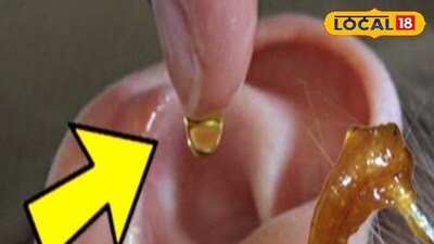 Safe Earwax Removal: Experts Advise Home Remedies, Avoid Dangerous Tools
