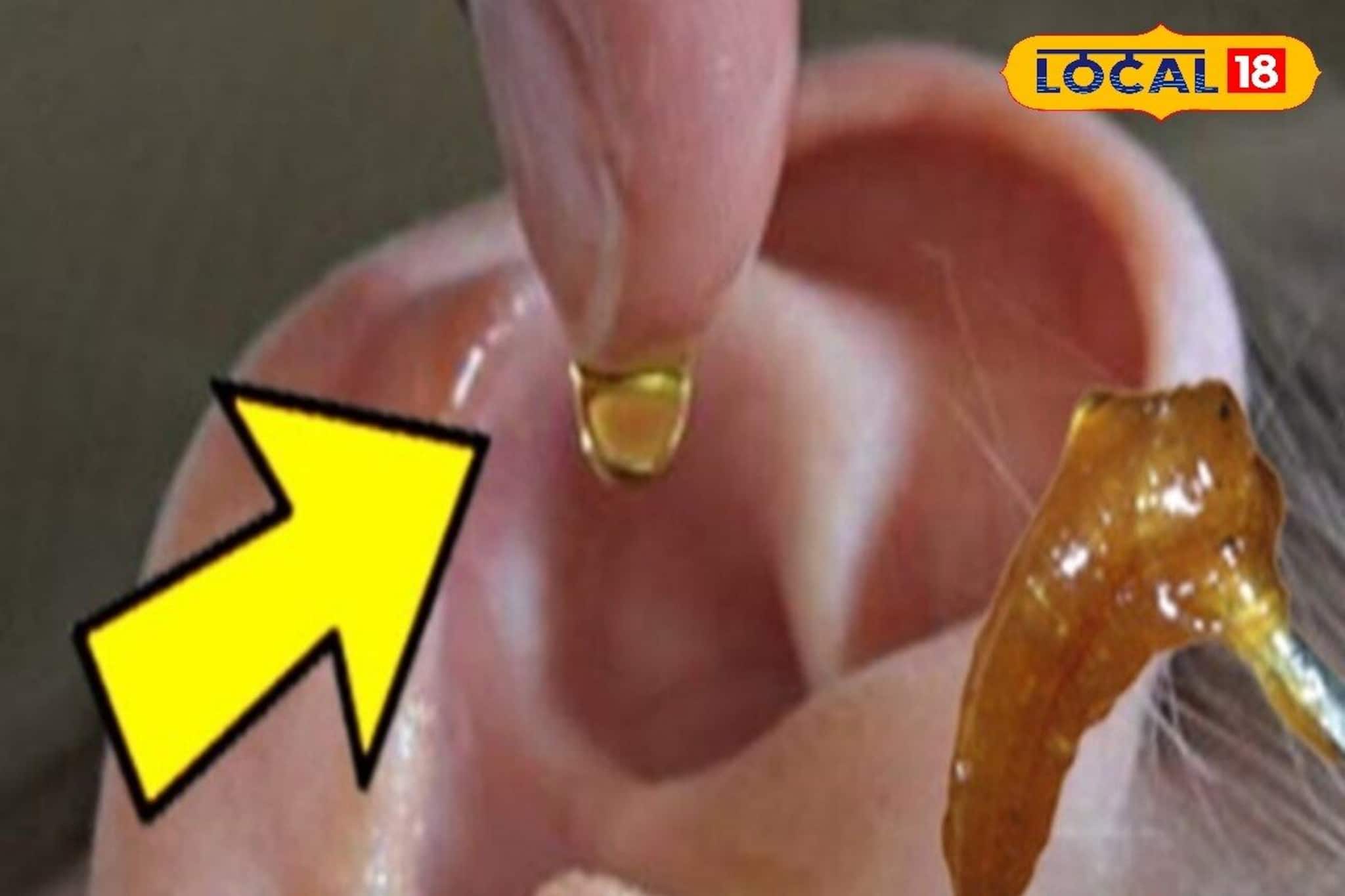 ব্যথা নয়, ঝামেলাও নয়! ঘরোয়া টোটকা মানলেই গলগল করে বেরিয়ে আসবে কানের সমস্ত জমে থাকা ময়লা! ব্যথা নয়, ঝামেলাও নয়! ঘরোয়া টোটকা মানলেই গলগল করে বেরিয়ে আসবে কানের সমস্ত জমে থাকা ময়লা!