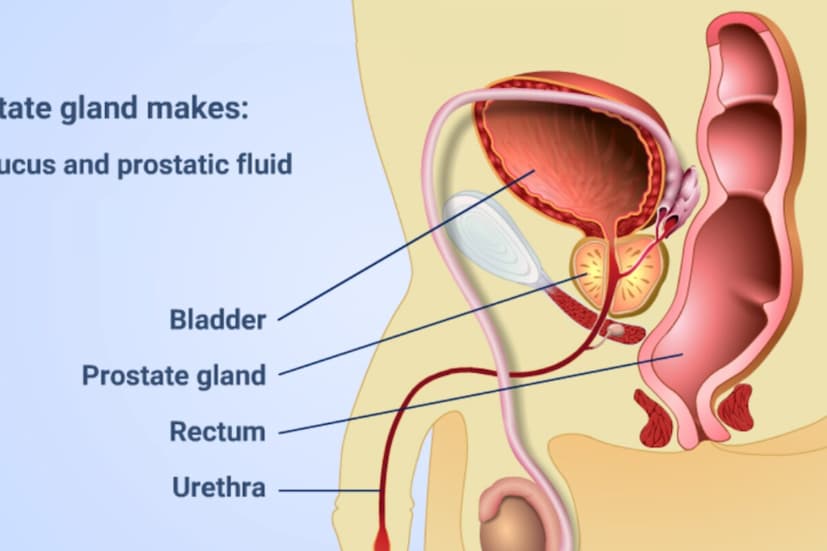 *প্রস্টেট ক্যানসারের লক্ষণঃ এই ক্যানসারের লক্ষণগুলির মধ্যে রয়েছে দুর্বল প্রস্রাব প্রবাহ, চাপ, দীর্ঘক্ষণ প্রস্রাব, দেরিতে প্রস্রাব শুরু হওয়া, ঘন ঘন প্রস্রাব হওয়া, রাতে ঘন ঘন প্রস্রাব হওয়া এবং প্রস্রাব নিয়ন্ত্রণ করতে অক্ষমতা। কখনও কখনও, প্রস্রাবের পরেও মূত্রাশয় পূর্ণ বোধ করা, প্রস্রাবে বীর্য বা রক্ত, তলপেটে ব্যথা এবং হঠাৎ ওজন হ্রাসের মতো সমস্যা দেখা দেয়। এই সমস্ত লক্ষণগুলিকে লোয়ার ইউরিনারি ট্র্যাক্ট সিমপস (LUTS) বলা হয়।