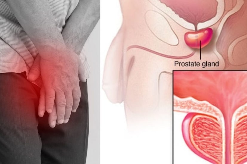 *IPSS স্কেল ব্যবহার করে এর তীব্রতা মূল্যায়ন করা যেতে পারে। তবে, সমস্ত ক্যানসার রোগীর মধ্যে এই লক্ষণগুলি উপস্থিত নাও থাকতে পারে। এই ক্যানসারগুলির বেশিরভাগই উপসর্গবিহীন।