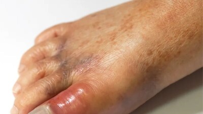 ইউরিক অ্যাসিড 