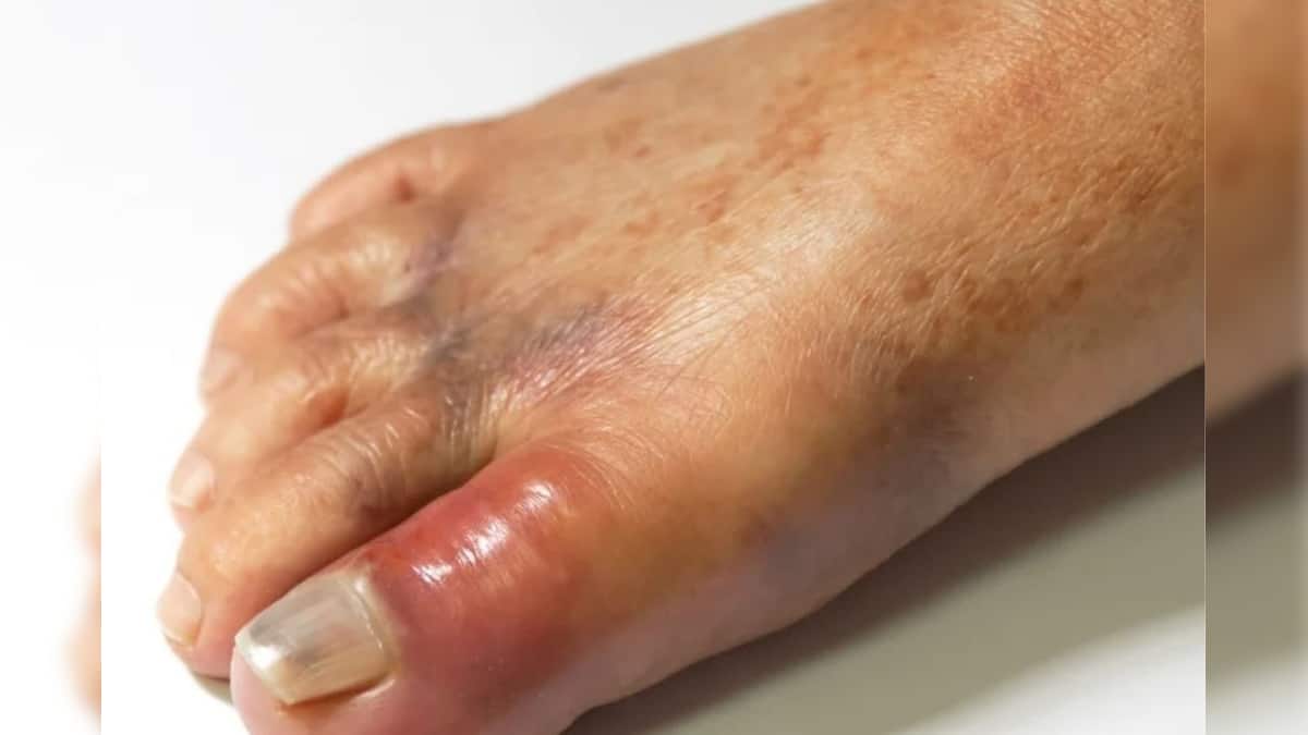 Uric Acid: না জেনেই পাতে রাখেন রোজ, পালংশাক-সহ ৫ সবজি হুড়মুড়িয়ে বাড়ায় ইউরিক অ্যাসিড, গাঁটে-হাড়ে ব্যথা এড়াতে খাবেন না