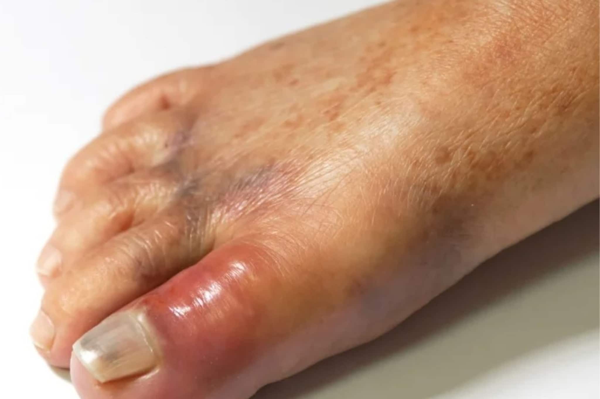 না জেনে পাতে রাখেন, পালংশাক-সহ ৫ সবজি হুড়মুড়িয়ে বাড়ায় ইউরিক অ্যাসিড, ব্যথা এড়াতে খাবেন না