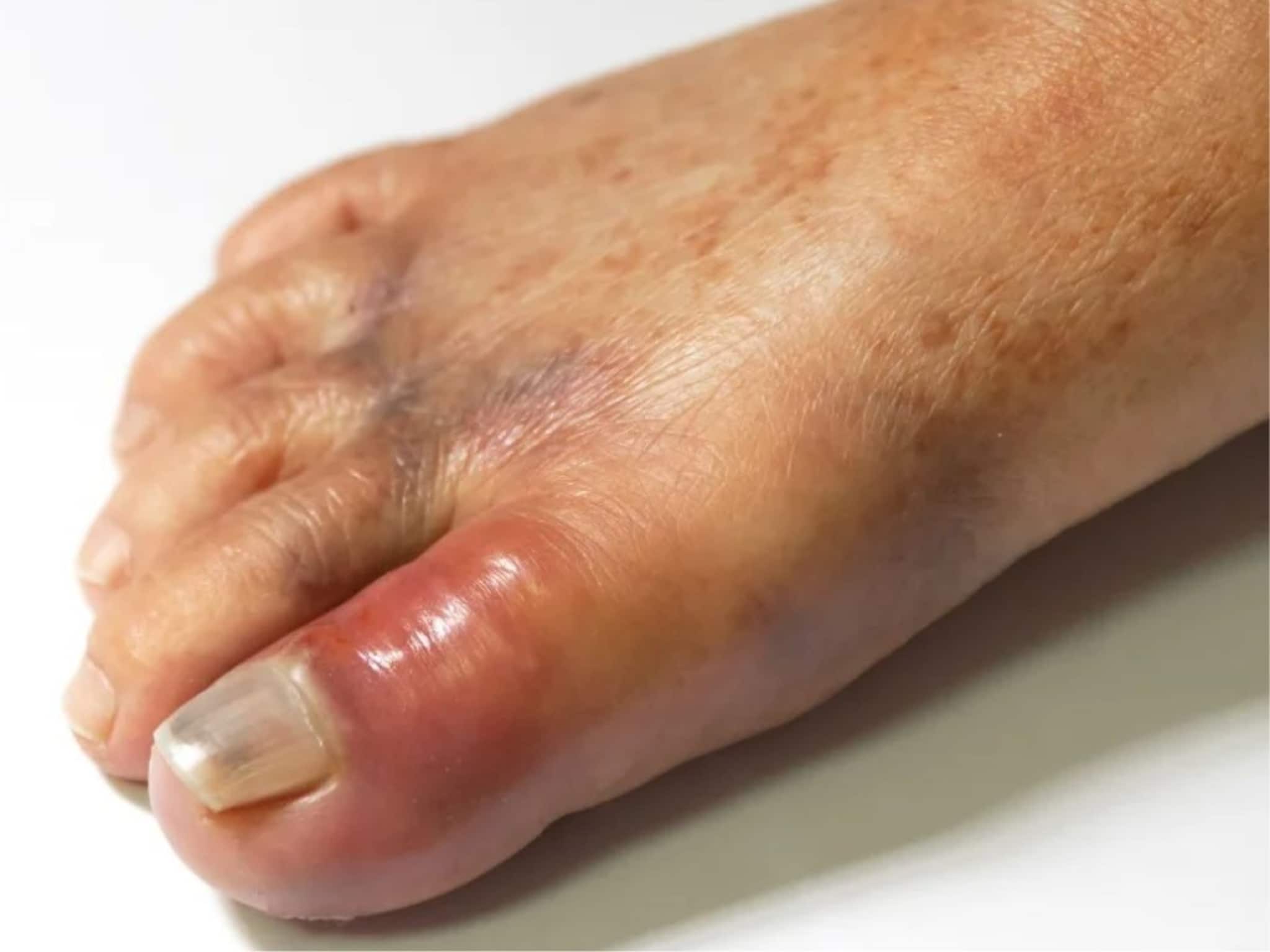 না জেনে পাতে রাখেন, পালংশাক-সহ ৫ সবজি হুড়মুড়িয়ে বাড়ায় ইউরিক অ্যাসিড, ব্যথা এড়াতে খাবেন না