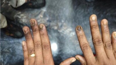 নখ কালচে ও ভঙ্গুর হয়ে যাচ্ছে? শরীরে বাসা বেঁধেছে কোন রোগ? প্রতিরোধই বা কী ভাবে? চিকিৎসকের পরামর্শ জেনে নিন