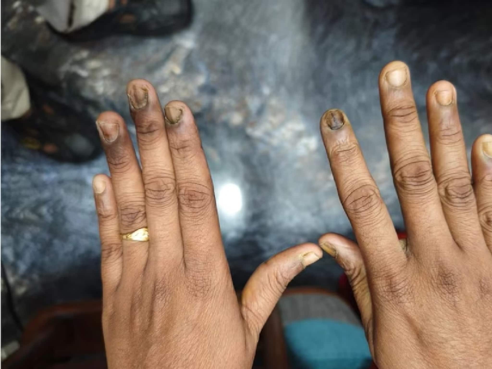 নখ কালচে ও ভঙ্গুর হয়ে যাচ্ছে? শরীরে বাসা বেঁধেছে কোন রোগ? প্রতিরোধই বা কী ভাবে? জানুন