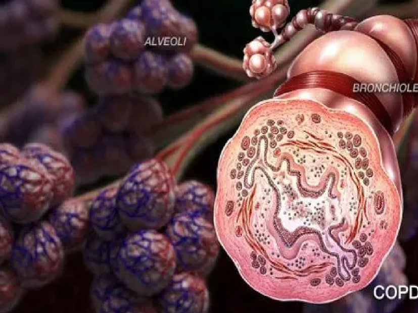 *শীতকাল আসার সঙ্গে সঙ্গে উত্তরবঙ্গ এবং হিমালয়ের পাদদেশে বসবাসকারী COPD রোগীরা প্রায়শই তাপমাত্রার হঠাৎ হ্রাসের কারণে তীব্র শারীরিক অবনতি অনুভব করেন। কেন এটি ঘটে তা জেনে রাখাই আদতে প্রতিরোধ এবং জীবনের উন্নত মানের প্রথম পদক্ষেপ। এই বিষয়ে আলোকপাত করছেন ডা. রাজেশ আগরওয়াল, কনসালটেন্ট, পালমোনোলজি, মণিপাল হাসপাতাল শিলিগুড়ি, পশ্চিমবঙ্গ। সংগৃহীত ছবি। 