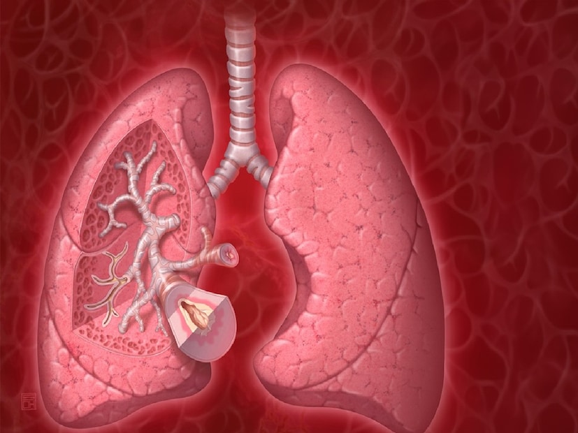 *COPD ম্যানেজমেন্টের মূল কথাঃ COPD শুধুই একটি দীর্ঘস্থায়ী রোগ নয়, বরং একটি দৈনন্দিন চ্যালেঞ্জ যা আমাদের অঞ্চলের অনেক মানুষ নীরবে মোকাবিলা করে। তাপমাত্রার হঠাৎ হ্রাস কীভাবে ফুসফুসের কার্যকারিতাকে প্রভাবিত করে তা জানা রোগীদের দ্রুত প্রতিক্রিয়া জানাতে এবং জটিলতা প্রতিরোধ করতে সক্ষম করে। শিলিগুড়ির মণিপাল হাসপাতাল প্রতিরোধমূলক কৌশল, সময়মতো রোগ নির্ণয় এবং পার্সোনালাইজড শ্বাসযন্ত্রের যত্নের উপর দৃষ্টি নিবদ্ধ করে। কাঠামোগত পালমোনারি রিহ্যাবিলিটেশন, প্রমাণ-ভিত্তিক চিকিৎসা এবং উন্নত ডায়াগনস্টিক সহায়তার মাধ্যমে আমাদের লক্ষ্য হল সিওপিডি রোগীদের ঋতু পরিবর্তনের মধ্য দিয়ে নিরাপদে এবং সর্বোত্তম মানের জীবনযাপন করতে সহায়তা করা। সংগৃহীত ছবি। 