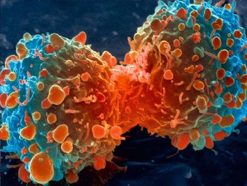 *চিকিৎসার বিকল্প: প্রস্টেট ক্যানসারের রোগীর চিকিৎসার জন্য, ডাক্তাররা রোগের পর্যায়, লক্ষণ এবং বয়সের মতো বিষয়গুলি বিবেচনা করেন। যদি রোগটি প্রাথমিক পর্যায়ে থাকে, তাহলে সক্রিয় নজরদারি, র&#x200d;্যাডিকাল প্রস্ট্যাটেক্টমি এবং রেডিয়েশন থেরাপি করা হয়। যদি এটি স্থানীয়ভাবে উন্নত পর্যায়ে থাকে, তাহলে এগুলির সঙ্গে স্বল্পমেয়াদী হরমোন থেরাপি করা হয়। এখন, উচ্চ ঝুঁকিপূর্ণ রোগীদের ক্ষেত্রে, লিম্ফ নোড অপসারণ, দীর্ঘমেয়াদী হরমোন থেরাপি এবং রেডিয়েশন থেরাপি করা হয়। মেটাস্ট্যাটিক পর্যায়ে থাকা রোগীদের ক্ষেত্রে, কেমোথেরাপি এবং হরমোন চিকিৎসা করা হয়।