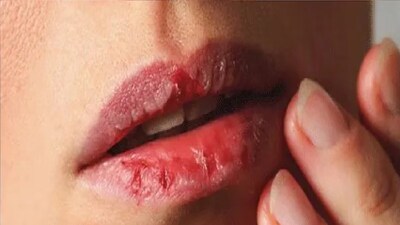 শীতে ঠোঁট ফাটা খুবই সাধারণ সমস্যা বলেই জানি আমরা। এ সময় এমন কেউ নেই, যার ঠোঁট ফাটে না। ছোট থেকে বড় সবারই ঠোঁট শুষ্ক থাকে ও ফেটে যায়। সাধারণত বাতাসে জলীয় বাষ্পের পরিমাণ অন্য ঋতুর থেকে শীতে কম থাকার কারণে ঘাম কম হয়। 