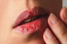 Cracked Lips Problem in Winter: শীতের শুষ্কতায় ঠোঁট ফেটে চৌচির? ক্রিম ডলে ডলেও কোনও লাভ হচ্ছে না? শরীরে এই ভিটামিনের অভাব হতে পারে! জানুন