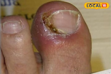 নখকুনি খুবই যন্ত্রণাদায়ক! নখের এই ফাঙ্গাল ইনফেকশন কমবে সহজেই, রইল ঘরোয়া টোটকা নখকুনি খুবই যন্ত্রণাদায়ক! নখের এই ফাঙ্গাল ইনফেকশন কমবে সহজেই, রইল ঘরোয়া টোটকা