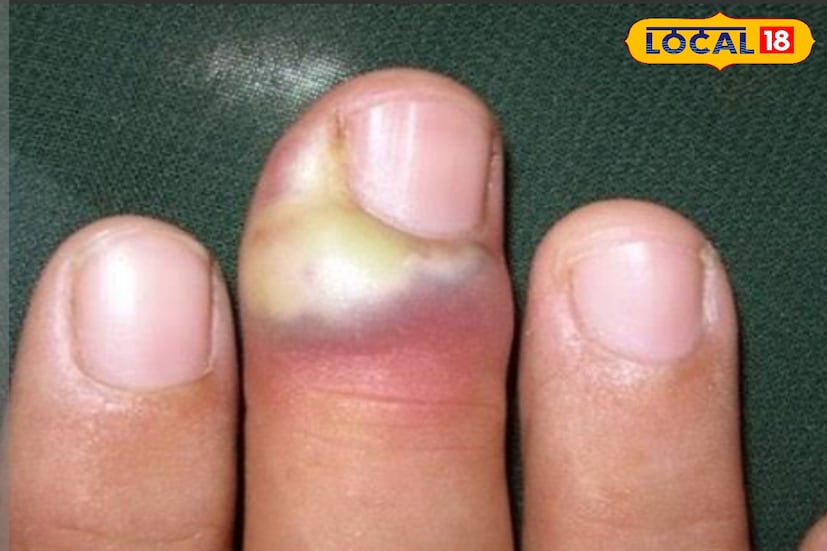 *পাতিলেবুও নখকুনির ঘরোয়া প্রতিকার। সংক্রামিত স্থানে কয়েক ফোঁটা লেবুর রস লাগিয়ে ২৫-৩০ মিনিট রেখে উষ্ণ গরম জলে ধুয়ে ফেলুন। ধারাবাহিকভাবে এক থেকে দুই সপ্তাহ করলে উপকার মিলবে।