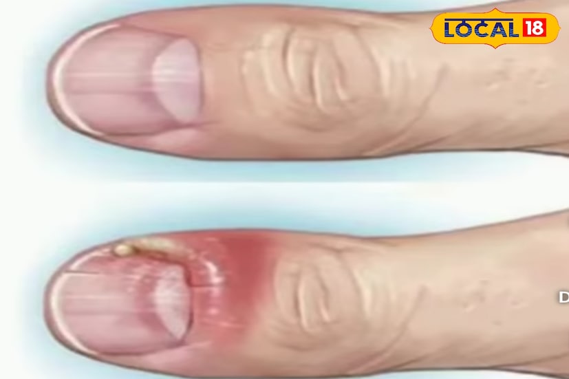 *এ ছাড়া ভুট্টার গুঁড়োও কাজে দেয়। গরম প্যানে ভুট্টার গুঁড়ো ভেজে জল মিশিয়ে পেস্ট তৈরি করে নখের গোড়ায় লাগালে দ্রুত কমে যায় যন্ত্রণা ও ফোলা।