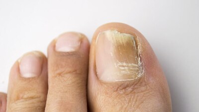 Sundarbans Nail Fungus: Home Remedies Ease Pain from Wet Conditions