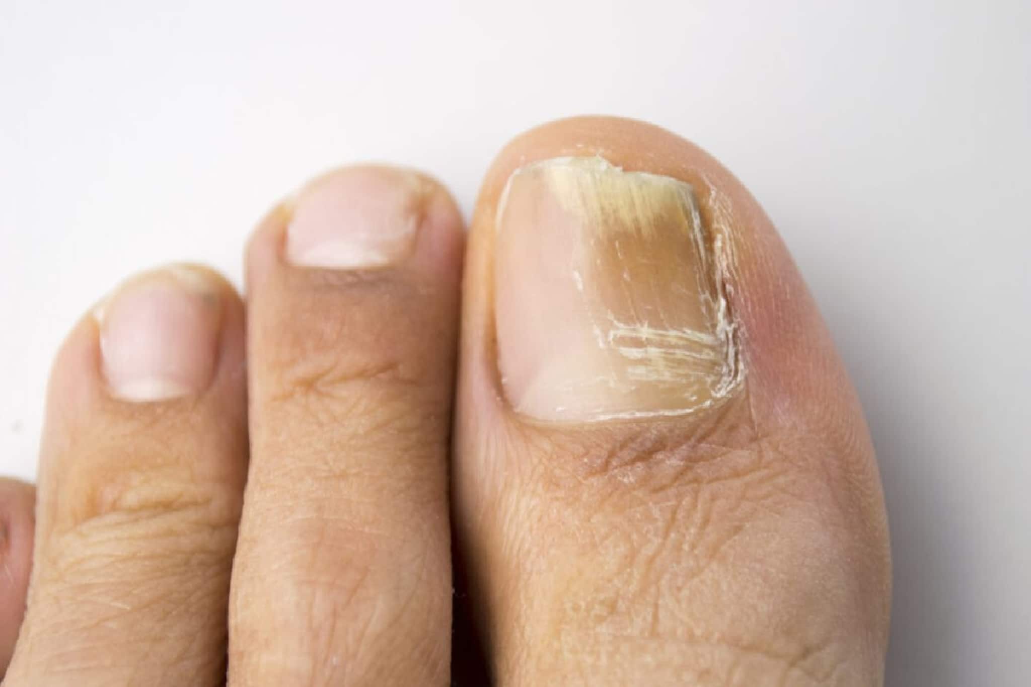 নখকুনি খুবই যন্ত্রণাদায়ক! নখের এই ফাঙ্গাল ইনফেকশন কমবে সহজেই, রইল ঘরোয়া টোটকা