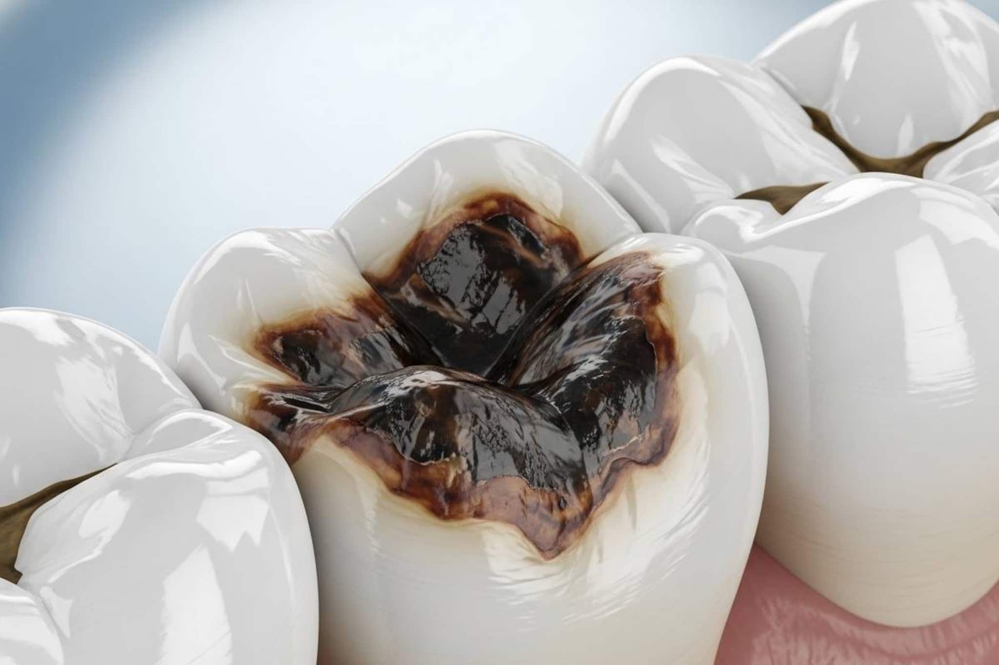 ১ কোয়া রসুন, পেঁয়াজ, কয়েকটা পুদিনাপাতা...ক্যাভিটিতেই দিলেই গায়েব পোকা খাওয়া দাঁতের ব্যথা! ১ কোয়া রসুন, পেঁয়াজ, কয়েকটা পুদিনাপাতা...ক্যাভিটিতেই দিলেই গায়েব পোকা খাওয়া দাঁতের ব্যথা!