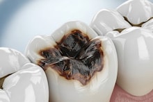 Dental Problem: ১ কোয়া রসুন, পেঁয়াজ, কয়েকটা পুদিনাপাতা...ক্যাভিটিতেই দিলেই গায়েব পোকা খাওয়া দাঁতের ব্যথা! দূর মুখের পচা দুর্গন্ধ!