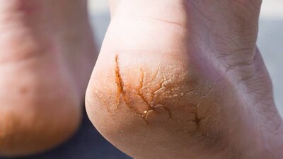 শীতে গোড়ালি ফাটার কিছু সাধারণ কারণ হল স্থূলতা, পা না ঢাকা জুতো পরা, দীর্ঘ ক্ষণ দাঁড়িয়ে থাকা, শুষ্ক ত্বক এবং সঠিক যত্ন, ভিটামিন সি এবং স্বাস্থ্যবিধির অভাব। আমাদের রান্নাঘরটি নিরাময় বৈশিষ্ট্য এবং ঔষধি মূল্যের চমৎকার উপাদানের ভান্ডার যা ফাটা গোড়ালি-সহ অনেক দৈনন্দিন সমস্যা নিরাময় করতে পারে।