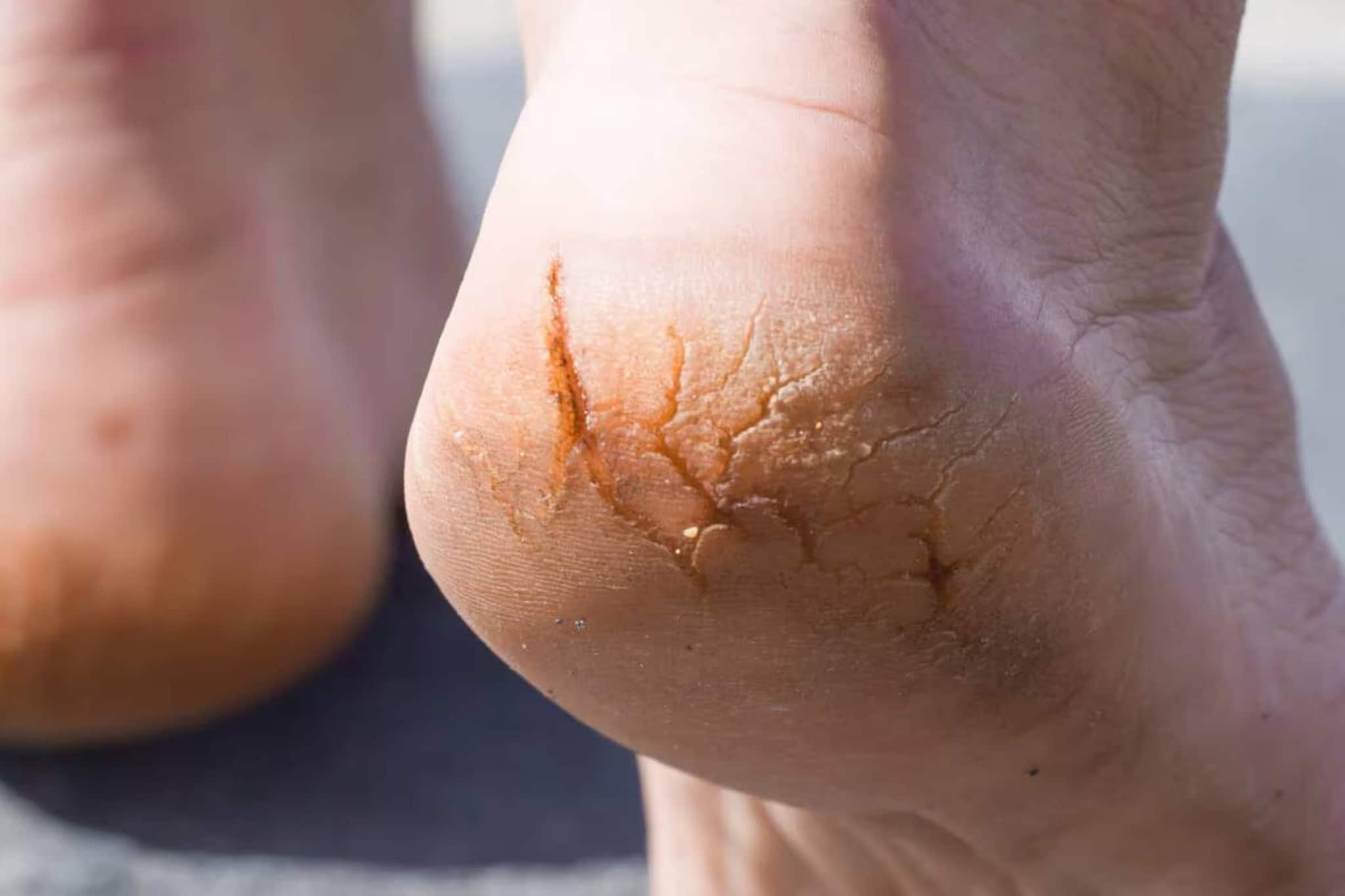 গোল্লায় যাক ফুট ক্রিম, পার্লারের পেডিকিয়োর! কয়েক ফোঁটা ঘি দিয়েই সারবে শীতের ফাটা পা! গোল্লায় যাক ফুট ক্রিম, পার্লারের পেডিকিয়োর! কয়েক ফোঁটা ঘি দিয়েই সারবে শীতের ফাটা পা!