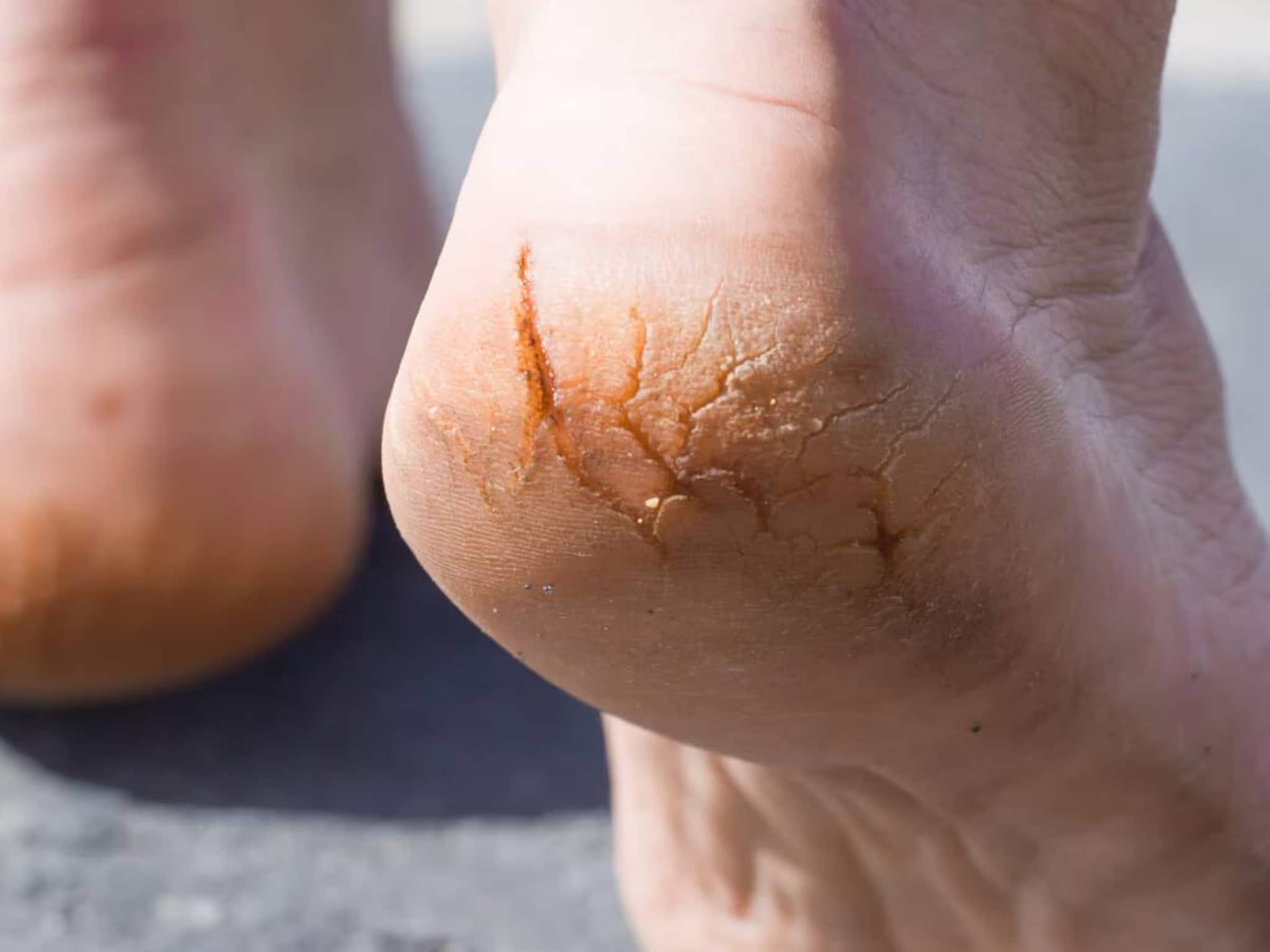 গোল্লায় যাক ফুট ক্রিম, পার্লারের পেডিকিয়োর! কয়েক ফোঁটা ঘি দিয়েই সারবে শীতের ফাটা পা! গোল্লায় যাক ফুট ক্রিম, পার্লারের পেডিকিয়োর! কয়েক ফোঁটা ঘি দিয়েই সারবে শীতের ফাটা পা!