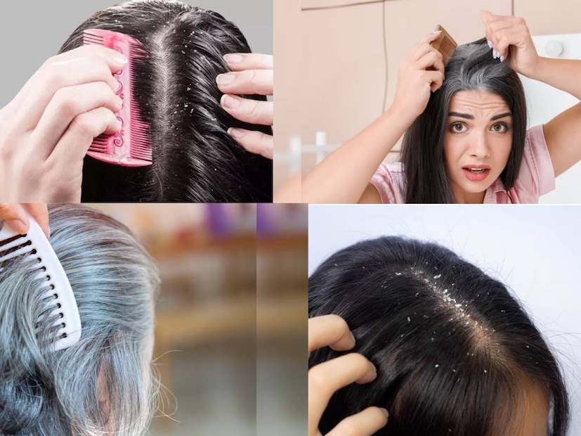 শীতকালে আপনার ত্বক শুষ্ক হয়ে যেতে পারে, তবে আর্দ্রতার অভাবে চুল বেশি পড়ে যা শুষ্ক ও প্রাণহীন হয়ে পড়ে। শুষ্ক মাথার ত্বক চুলকানি, খুশকি এবং স্প্লিট এন্ডসের ঝুঁকিও বাড়িয়ে দিতে পারে। অতএব, চুল ভাঙা রোধ করতে এবং স্বাস্থ্যকর, চকচকে চেহারা বজায় রাখতে ঋতুভিত্তিক যত্ন নেওয়া অত্যন্ত গুরুত্বপূর্ণ।