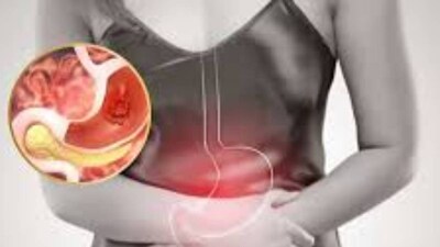 পাকস্থলীর ক্যানসার সবচেয়ে বিভ্রান্তিকর রোগগুলির মধ্যে একটি, যা প্রায়ই নীরবে বাড়ে এবং সাধারণ গ্যাস্ট্রিক সমস্যার মতো লক্ষণগুলি দেখা যায় শরীরে৷ যার ফলে রোগ নির্ণয়ে বিলম্বিত হয় এবং ফলাফল খারাপ হয়। প্রাথমিক পর্যায়ে রোগ শনাক্তকরণ এবং দ্রুত চিকিৎসা শুরু হলে পরিস্থিতি জটিল হয় না৷