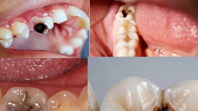 ঠান্ডা মরশুমে, মানুষ দাঁতের ব্যথায় খুব কষ্ট পায়